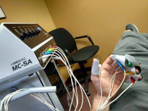 An image of what it looks like when calmare therapy is performed on a hand with CRPS