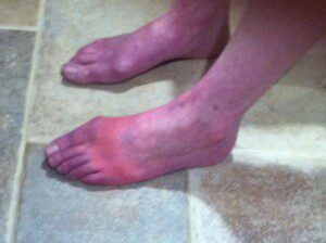 Nurse Beth's feet, which are normally affected by CRPS. She discusses the possible correlation between CRPS and GI issues