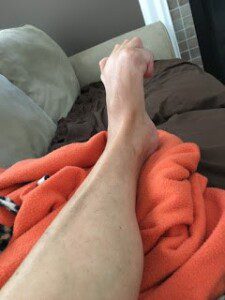Tracy gives us a glimpse into life with CRPS with dystonia, ketamine, and SCS