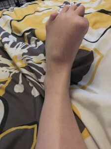 Tracy's foot with dystonia and CRPS before surgery and SCS and ketamine