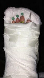 Tracy's foot post surgery with CRPS, dystonia, and impacted by SCS and ketamine