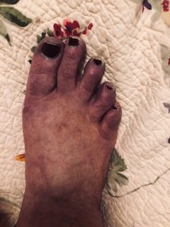 Kathleen Derby Feet CRPS