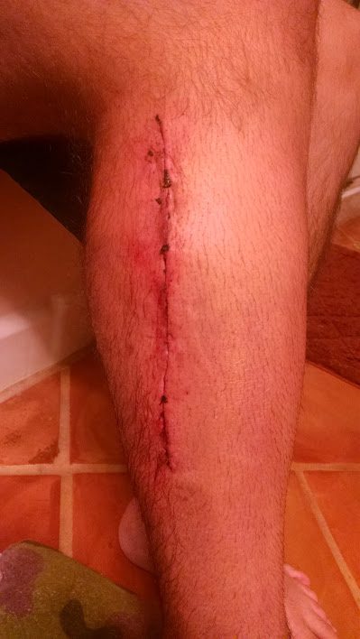 fibula surgery scar