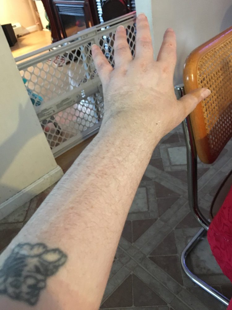 Hand and arm post-cast